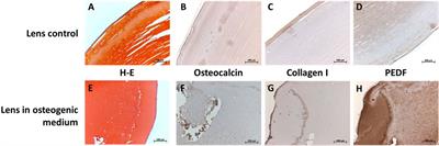 The human lens is capable of trilineage differentiation towards osteo-, chondro-, and adipogenesis—a model for studying cataract pathogenesis